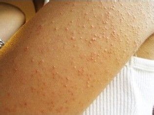 鸡皮疙瘩落不下去(鸡皮疙瘩下不去怎么回事)