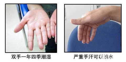 手汗症的症状 缓解手汗症的方法
