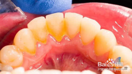 原来电动牙刷和普通牙刷差距那么大，医生这样建议