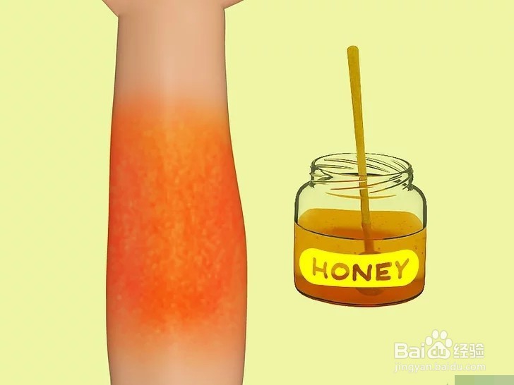 如何治疗烧伤？