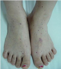 过敏性紫癜肾炎有哪些临床症状