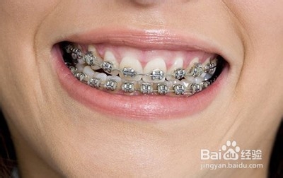 牙套什么材质的好？