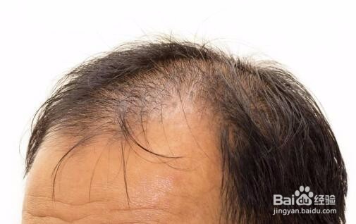 生发知识:脂溢性脱发治疗,关毛孔闭合了怎么办