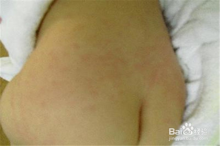 宝宝出疹子的护理和注意事项