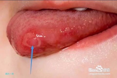 得了口腔溃疡怎么办,如何才能好的快/?