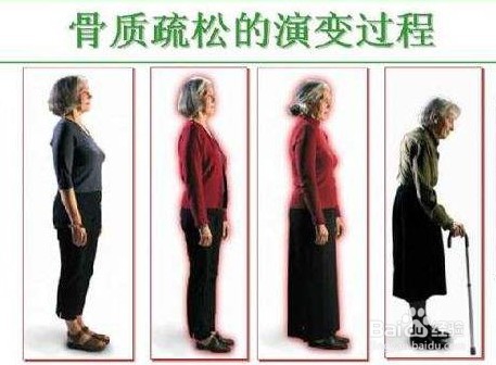 骨质疏松怎么办：日常需要注意哪三方面