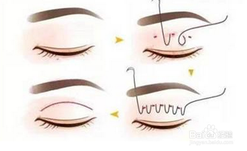 如何把双眼皮做得自然不露痕迹
