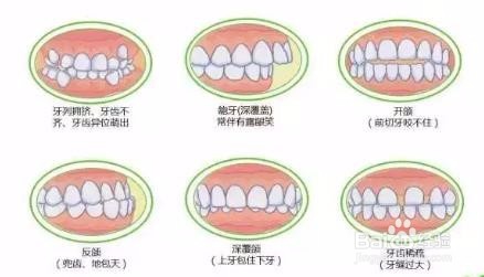 武汉牙齿矫正多少钱？其价格与这些因素有关