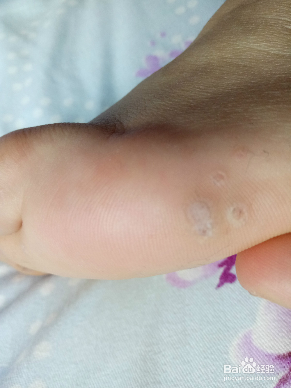 鸡眼治疗小方法