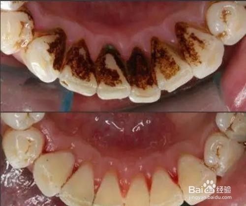 牙缝发黑