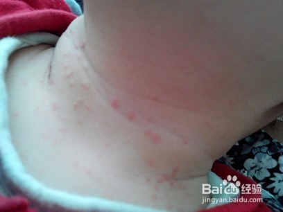 痱子种类大科普