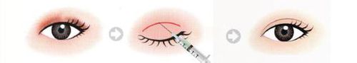 祛眼袋[3]韩式双眼皮手术方法