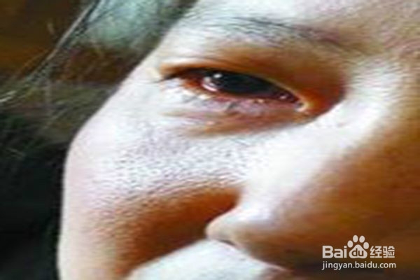 夏季谨防红眼病