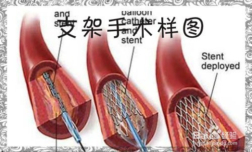 血管瘤堵塞治疗, 8种可以软化血管的食物