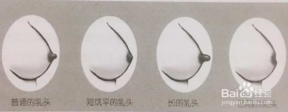 浆细胞性乳腺炎的预防与日常注意！