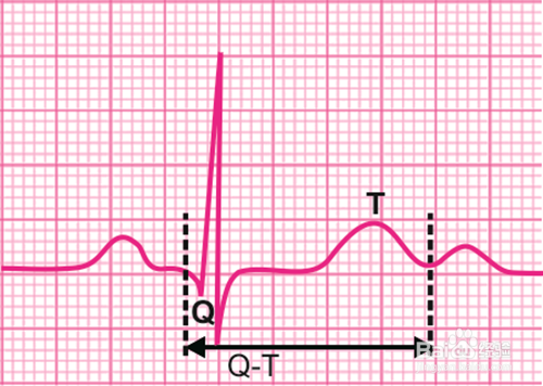 心電圖怎麼看,心電圖講解,心電圖t波改變