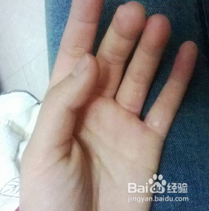 烫伤如何自行处理