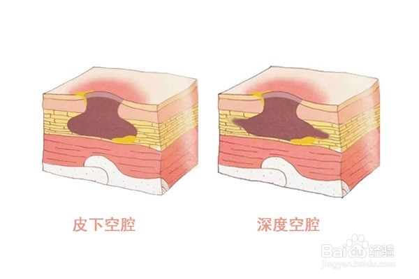 空腔型褥疮怎么治疗