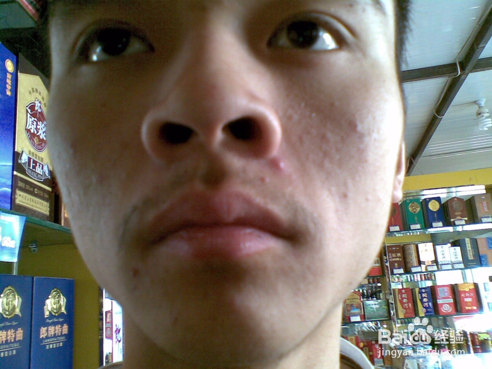 春季刮大风脸上起了好多豆豆咋办