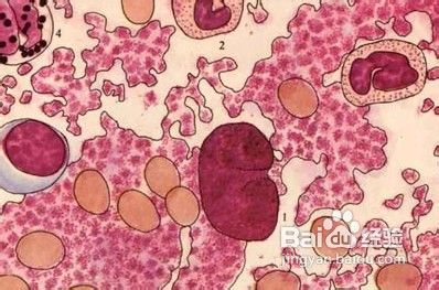 继发性血小板增多症发病机制