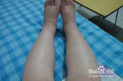 孕妇身体和脚浮肿的原因和消去浮肿的方法