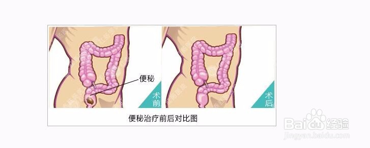 女性大便困难应该怎么解决