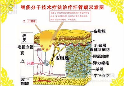 长汗管瘤需要忌口哪些食物？