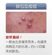 痘痘的种类有哪些