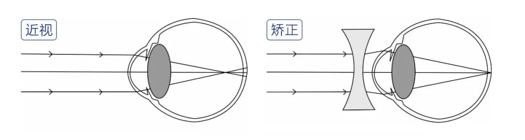 【科学辟谣】戴眼镜会导致近视度数越来越高？