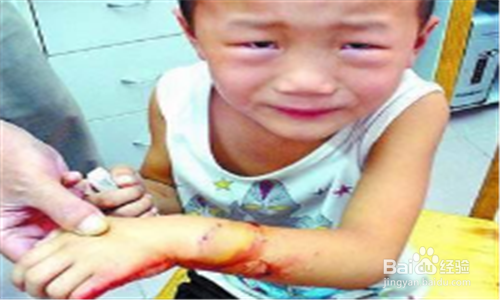 一周岁的小孩被自家的小狗咬了怎么办