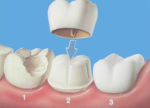 为什么牙齿要做根管治疗？根管治疗的步骤