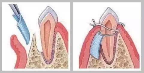 种植牙手术是如何操作的？