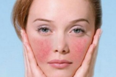 如何去除红血丝