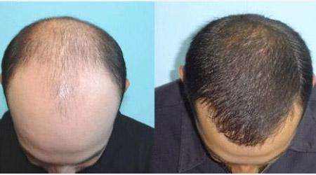 植发前要剪短头发吗