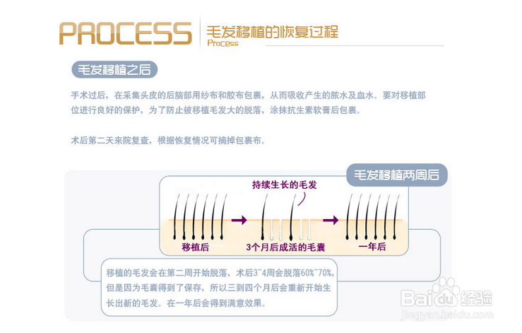 毛发移植技术是怎样的？