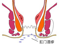 怎样分辨得了哪种痔疮