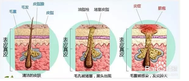 痤疮的形成原因是什么？有哪些去痘的有效方法？