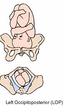 6  lop为左枕后,英文为 left occipitoposterior