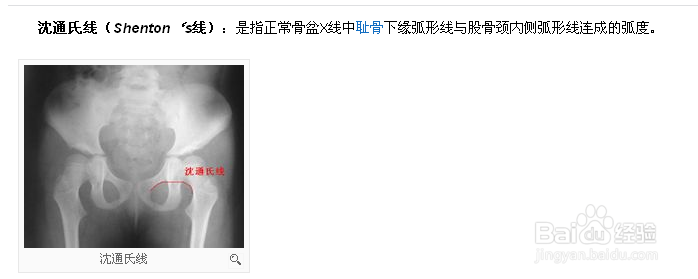怎么在X线平片上确诊先髋