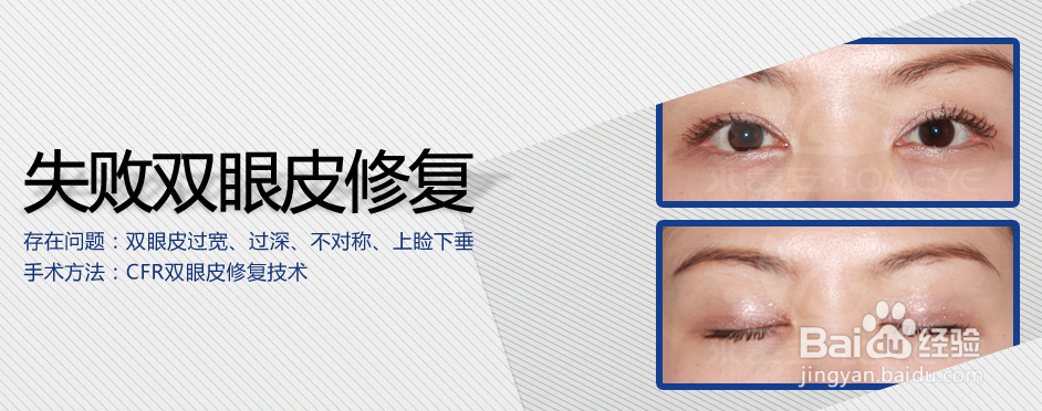 CFR双眼皮修复技术案例分享