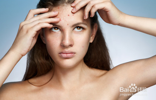 闭口粉刺如何快速消掉