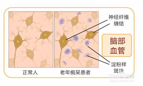 心腦血管疾病的預防要注意什麼?