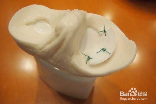 半月板损伤的症状及治疗方法