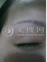 冲动下去种植眉毛，消肿中