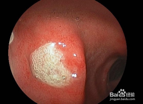 十二指肠溃疡四大危害