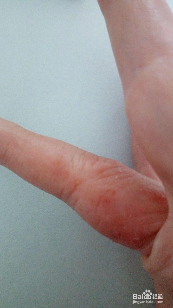 手指小水泡的治疗过程（真实经验）