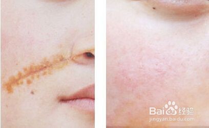 怎么祛陈年旧疤