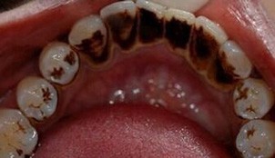 洗牙是最便宜的治疗
