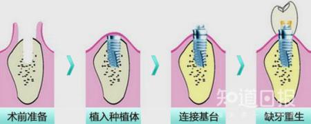 种植牙真的有那么好吗?