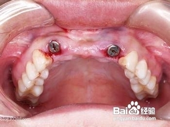 牙齿缺失了怎么办？